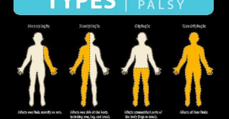 Cerebral Palsy Stem Cell Therapy India: A Ray of Hope for Patients
